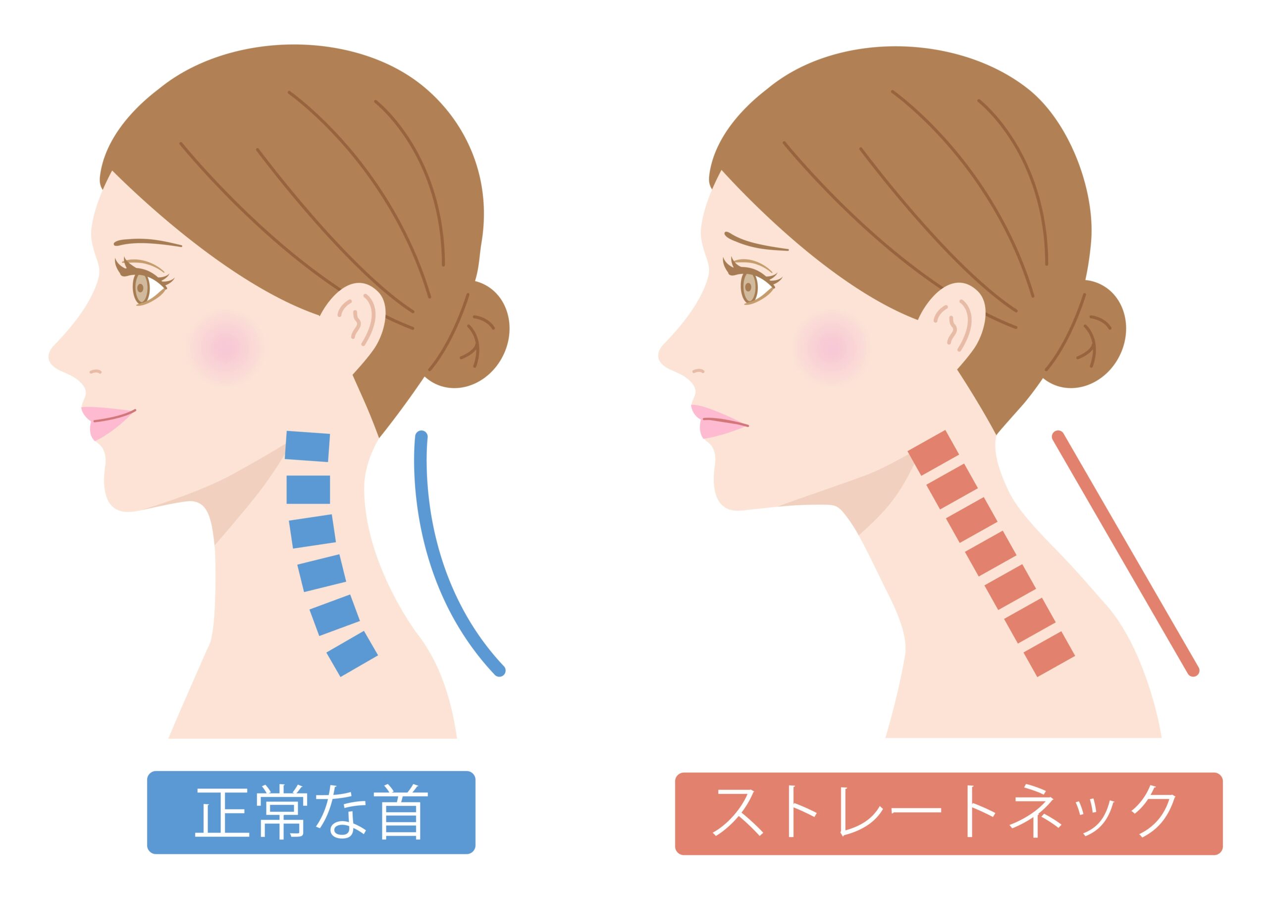 正常な首とストレートネックの比較のイラスト